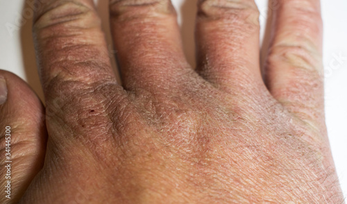 Man's hand with dry skin, cracked due to disinfectant solutions © bogdan vacarciuc