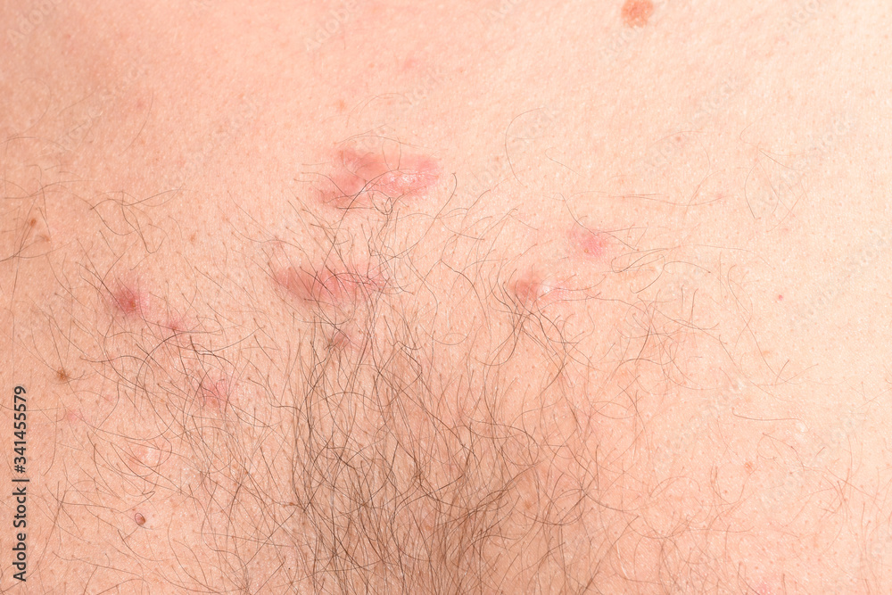 Fototapeta premium dermatological diseases of problem skin and hairline.