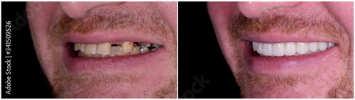 Tableau sur toile full mought recovery by press ceramic crowns and implants