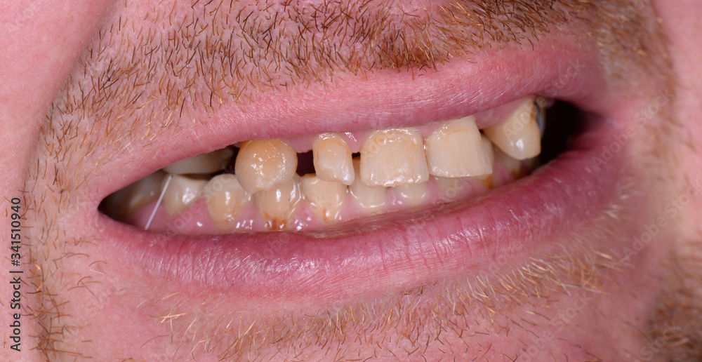 Obraz premium full mought recovery by press ceramic crowns and implants