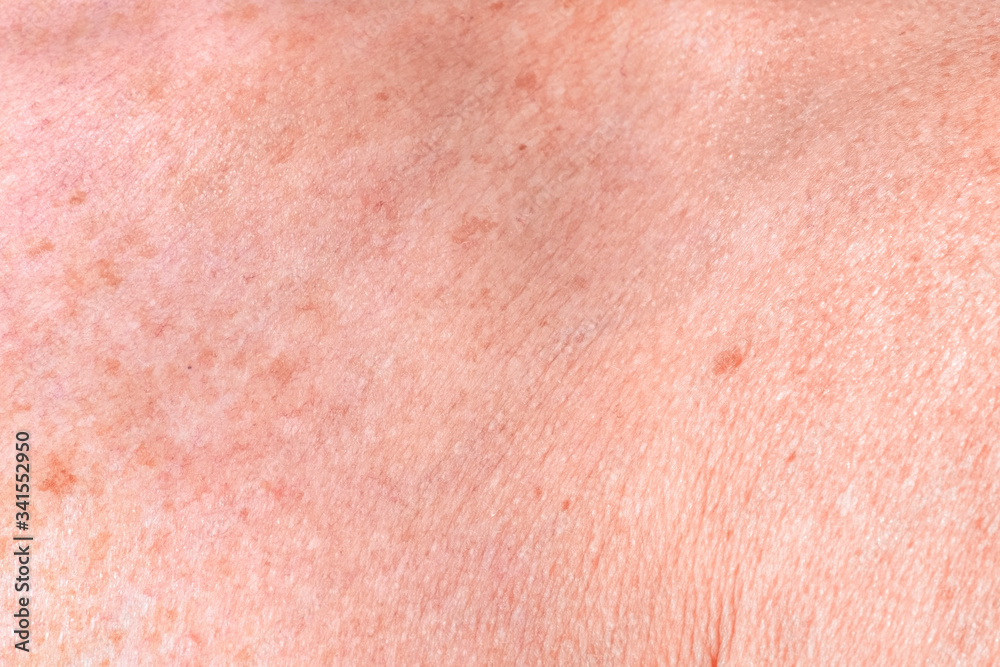 Aging female skin with melasma spots