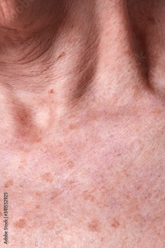 Aging female skin with melasma spots photo