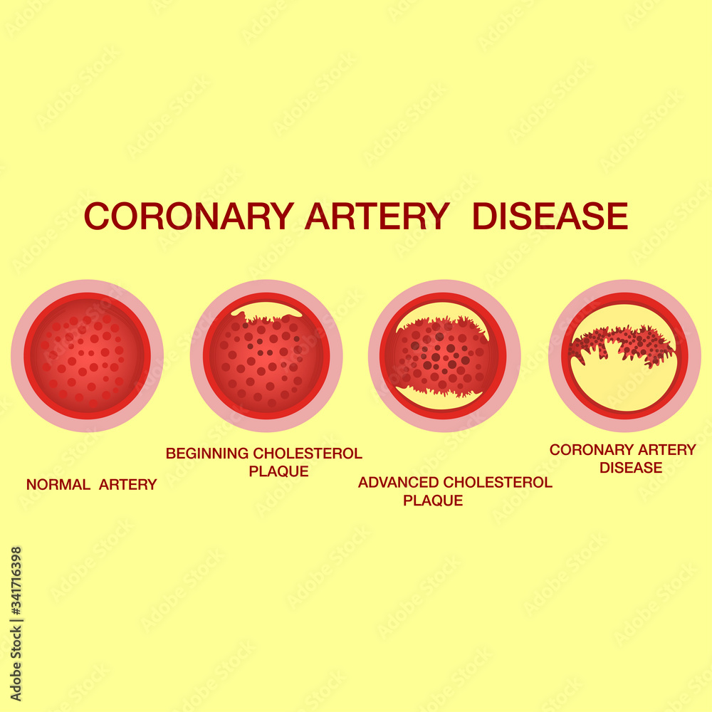 Coronary artery disease concept. Healthy and narrowed arteries with