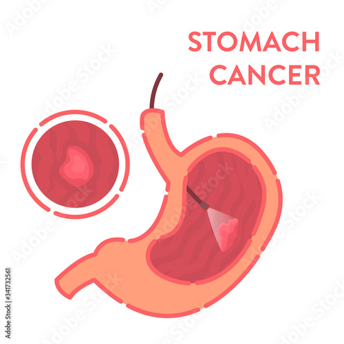 Gastroscopy procedure for stomach cancer disease diagnostics. Gastrointestinal tract examination. Health care and medical concept. Vector illustration in flat style. Human body organ disorder. 