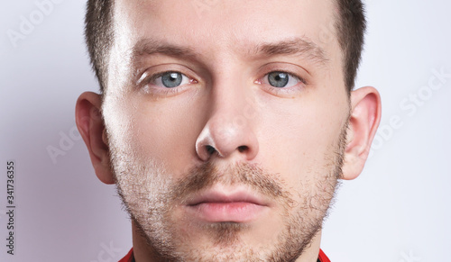 strabismus in a man