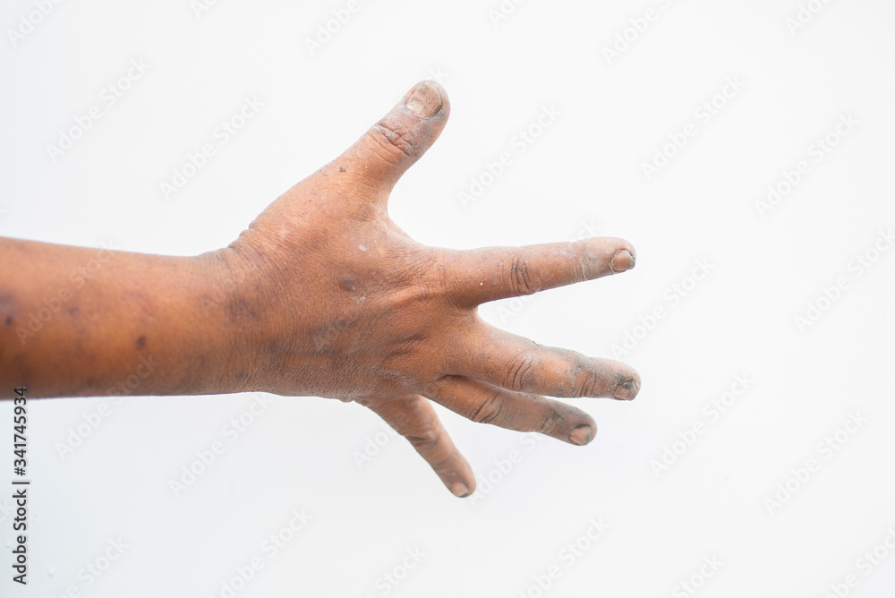 Trigger Finger a defect in a tendon causing a finger to jerk or snap straight when the hand is extended.