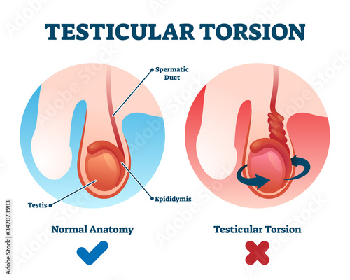 Testicular torsion vector illustration. Labeled spermatic cord twist scheme photo