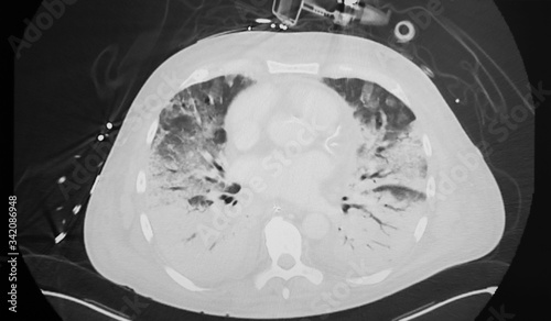 CT scan of a patient with COVID-19