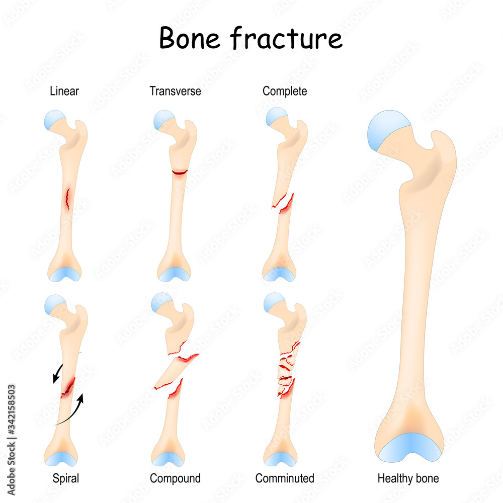 Typical bone fractures. Healthy femur and leg fracture in different stages. Typical bone fractures. Healthy femur and leg fracture in different stages.