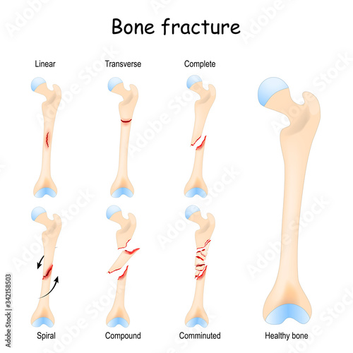 Typical bone fractures. Healthy femur and leg fracture in different stages.