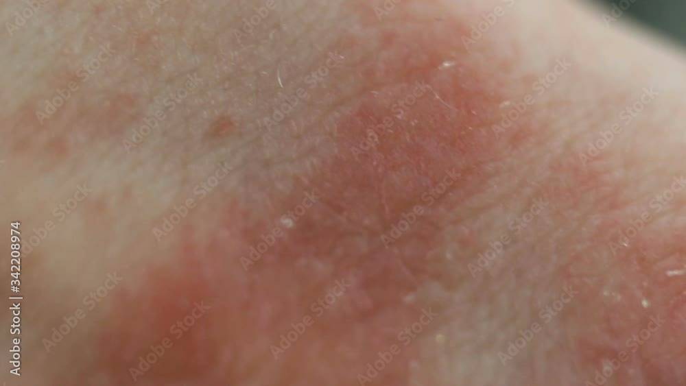 Red spots of the affected epithelium, severe itching, scabies. Atopic dermatitis from stress, allergies, fungal or bacterial infection, systemic lupus erythematosus, autoimmune processes. The affected Red spots of the affected epithelium, severe itching, scabies. Atopic dermatitis from stress, allergies, fungal or bacterial infection, systemic lupus erythematosus, autoimmune processes. The affected