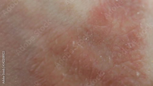 The affected skin is extremely close-up, real time, contains people. Atopic dermatitis from stress, allergies, fungal or bacterial infection, systemic lupus erythematosus, autoimmune processes. Red sp photo