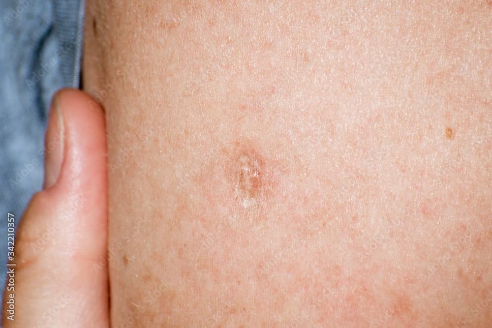 Close up of Bacillus Calmette-Guérin (BCG) vaccine scar mark in the upper left arm of an adult person; BCG vaccine is usually administered to newborns and primarily used against tuberculosis (TB)