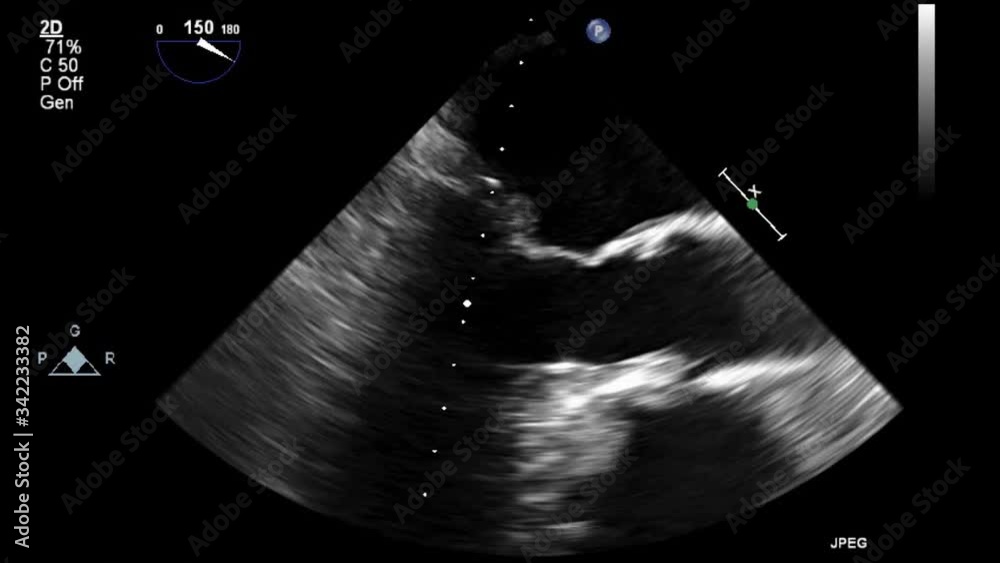 Transesophageal ultrasound video in gray-scale mode.