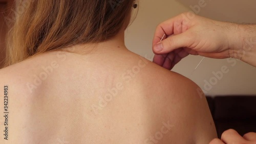 Acupuncturist doctor inserting needles into a shoulder of young caucasian woman and twisting it photo