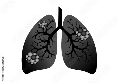 Comparison between healthy lung and cancer lung isolated on white background. Healthy lung and 
Pneumonia. Lung was infected by pathogen 