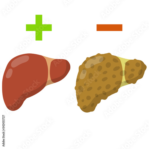 Healthy and diseased liver. Comparison of the medical condition of human organs. Flat cartoon. Health problem and treatment