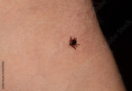 A small tick on a child’s leg. Dangerous insect, the carrier of many diseases.