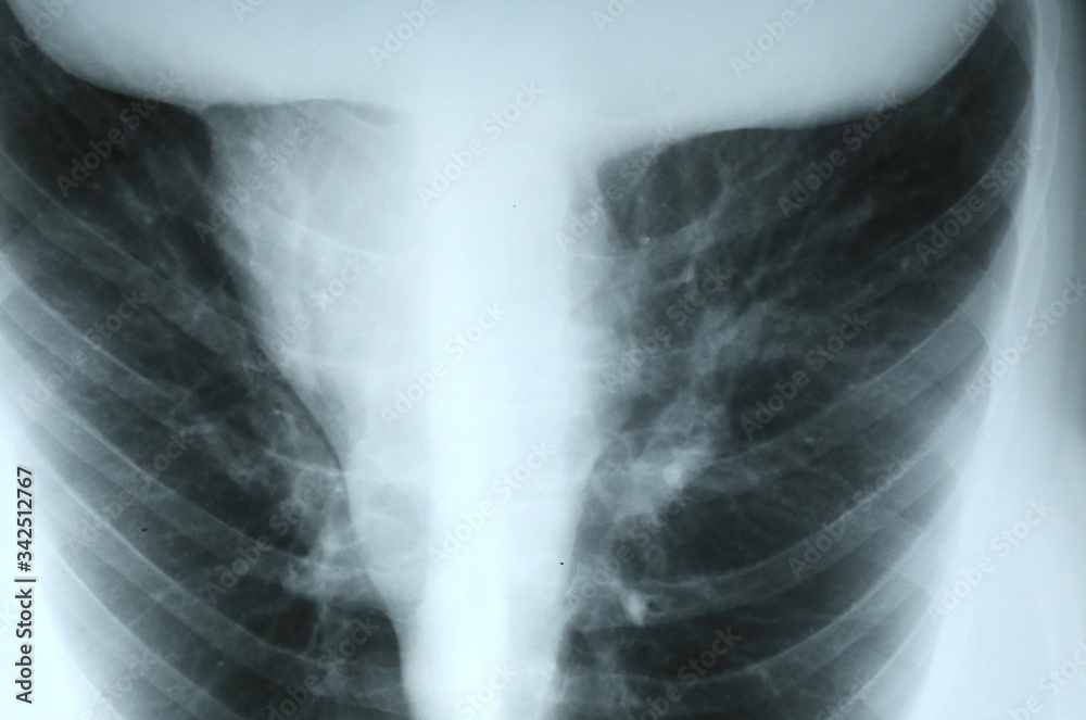 Lungs and rib cage x-ray image Lungs and rib cage x-ray image