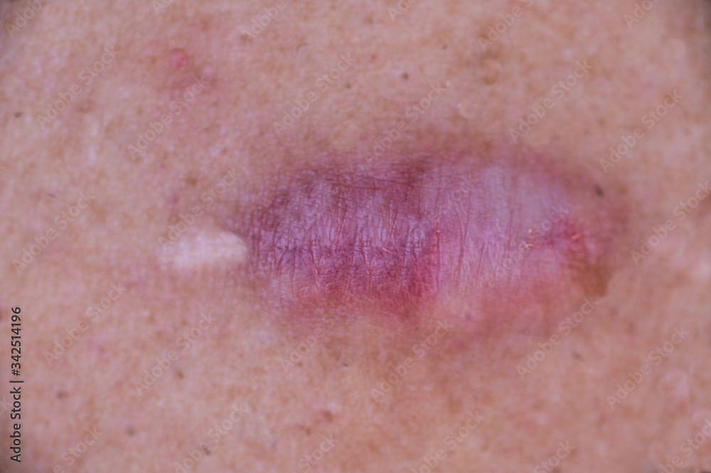 Fototapeta premium Surgical scar morphed into keloid