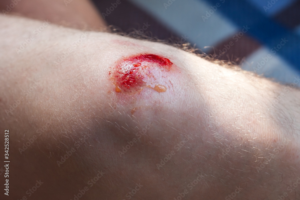 Deep scratches on the skin with bruises and wet tracks Deep scratches on the skin with bruises and wet tracks
