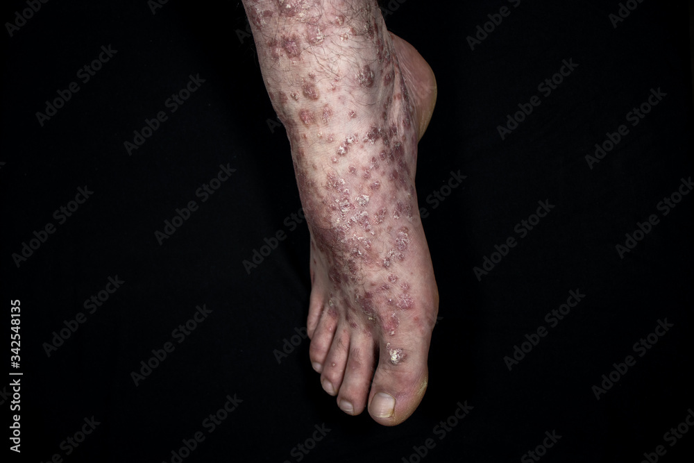 Fototapeta premium Psoriasis (eczema) on foot isolated on black background