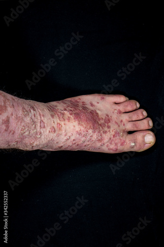 Psoriasis  eczema  on foot isolated on black background