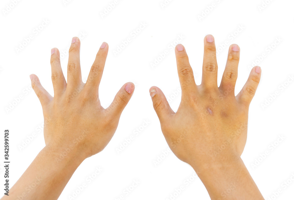 sunburn and nail infection of hands and arms of human isolated sunburn and nail infection of hands and arms of human isolated