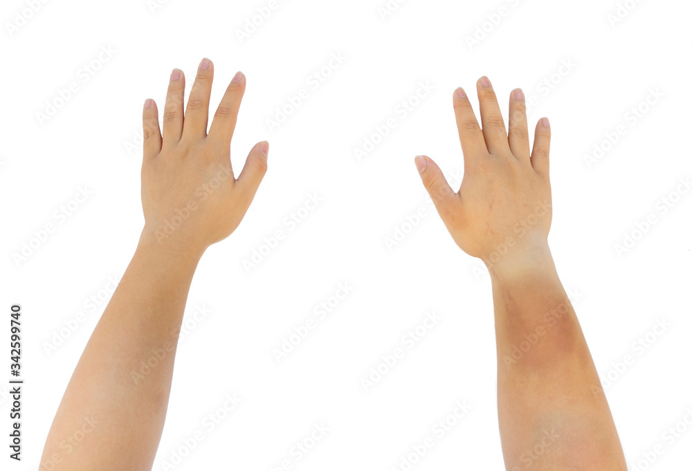 sunburn and bruise of hands and arms of human isolated sunburn and bruise of hands and arms of human isolated