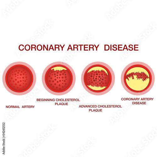 Coronary artery disease concept. Healthy and narrowed arteries with plaques. The accumulation of cholesterol in the blood vessels.Illustration isolated on white background.Atherosclerosis of blood