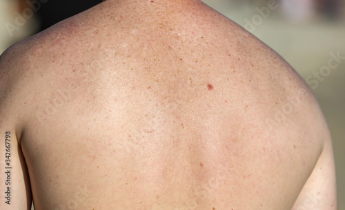 The bare back of a man with traces of freckles.