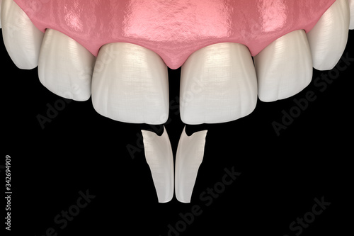 Diastema treatment: Micro veneer installation procedure over central incisor. Medically accurate tooth 3D illustration