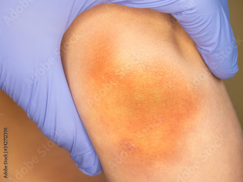 Arm of handsome boy with big bruise on forearm