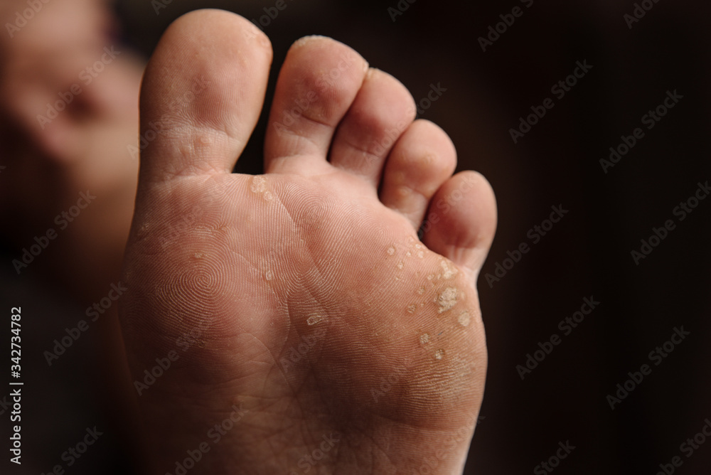 Obraz premium Fungus on the toes close up