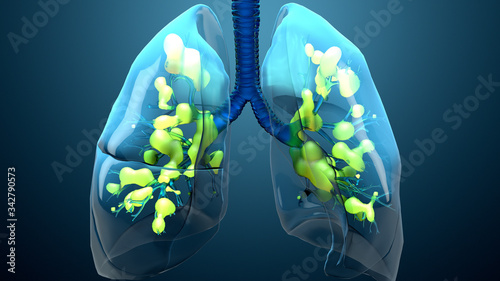 Damage lungs, severe respiratory illness, pneumonia, ARDS, acute respiratory distress syndrome caused by the coronavirus photo