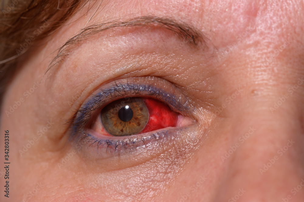 Obraz premium Frau mit Bindehautentzündung im Auge