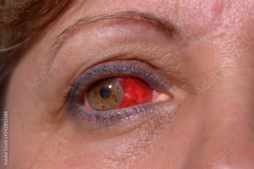 Frau mit Bindehautentzündung im Auge