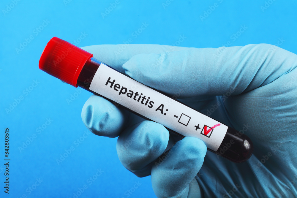 Obraz premium Vacuum test tube with blood in the doctor's hand. blood test for hepatitis A. Blue background.