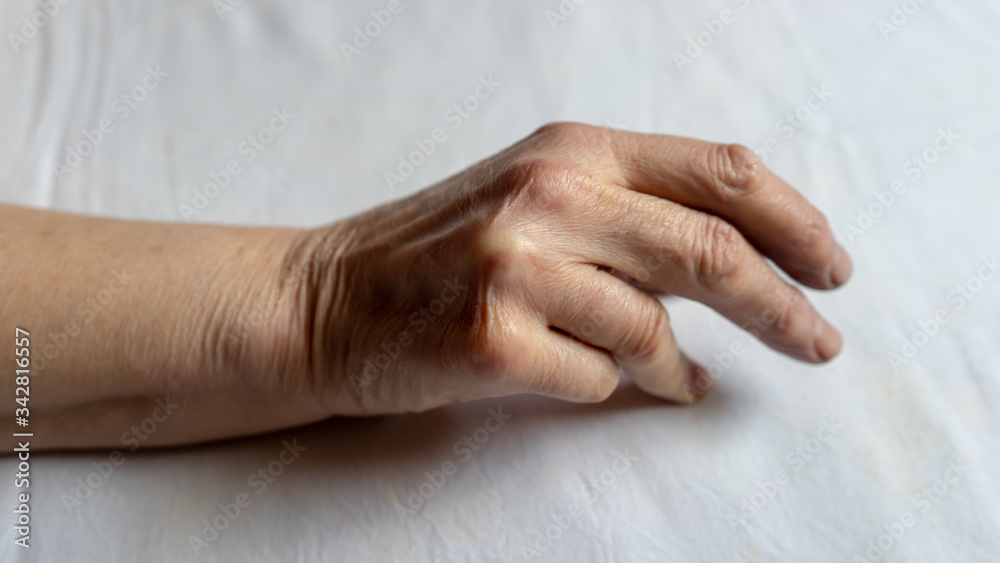 Hands of a woman with twisted fingers. Dupuytren's contracture disease. Hands of a woman with twisted fingers. Dupuytren's contracture disease.