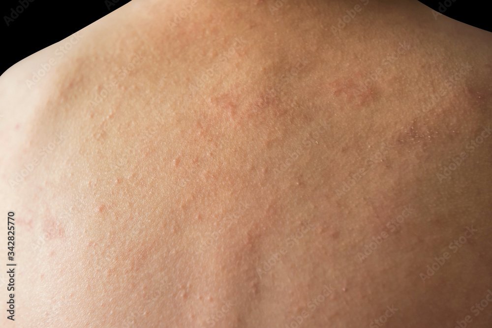 Child back with rash allergy skin Child back with rash allergy skin