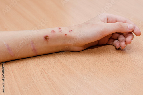 burns and scars from cuts on the arm. photo