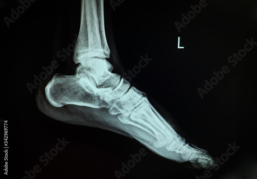 x-ray image show side left foot.