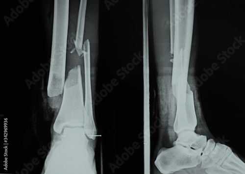 film x-ray of fracture of left ankle.