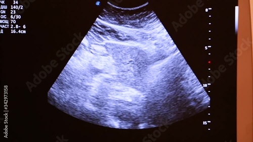 Monitor screen of a working, modern, ultrasound machine on which a medical study is conducted. Slight camera movement. Close-up. Soft light.