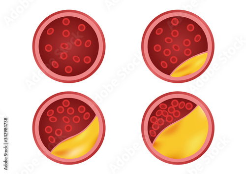 Atherosclerosis stage in human blood / cholesterol  vector