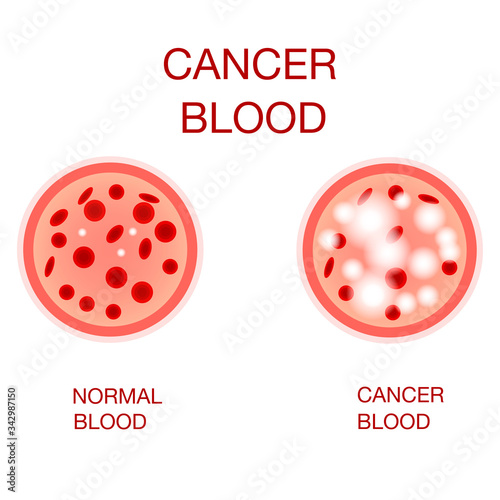Infographic image of leukemia. Leukaemia disease awareness.Leukemia Blood Cells And Normal Blood Cells White Blood Cells Monocyte . Realistic vector picture .Medical and healthcare concept