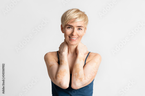 Portrait of woman with vitiligo, no makeup