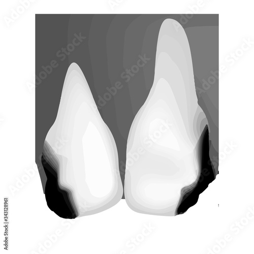 Dental caries. X-ray of tooth decay. Caries infographics. Vector illustration on isolated background.