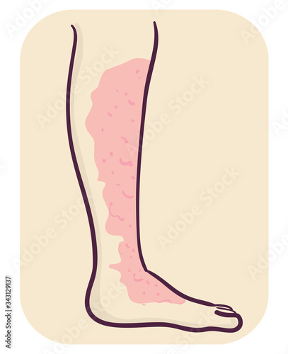 Symptom Leg Cellulitis Illustration