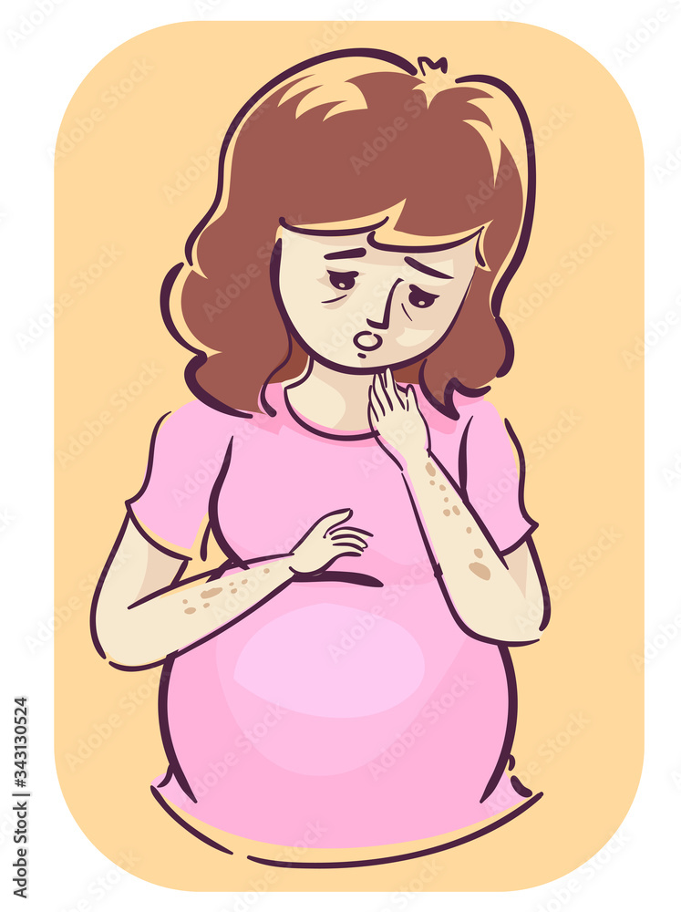 Pregnant Skin Discoloration Symptoms Illustration Pregnant Skin Discoloration Symptoms Illustration